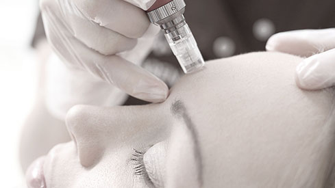 micro-needling-2-489x275.jpg